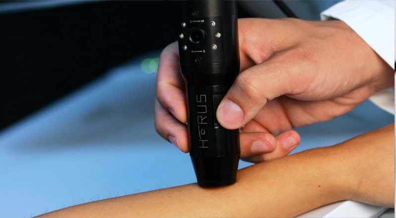 horus 200, camera dermatoscopului